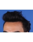 After Hair Transplant&nbsp;Front